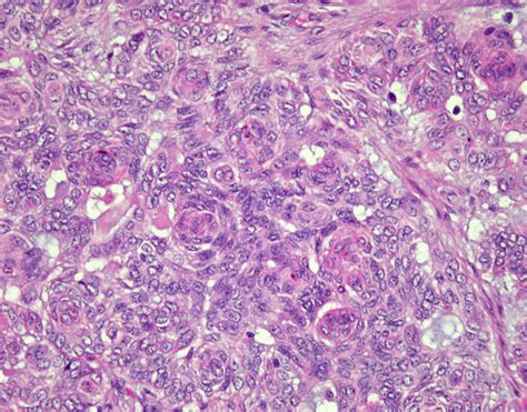 Pathology Outlines Polymorphous Sweat Gland Carcinoma