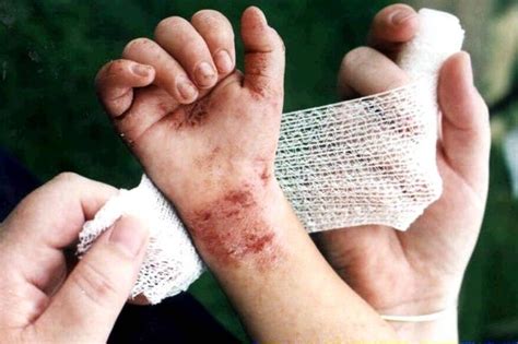 10 Childhood Skin Rashes And How To Identify Them Derbyshire Live