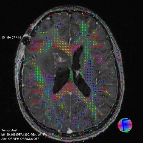 Check spelling or type a new query. DTI (Diffusion tensor imaging) | Medinst