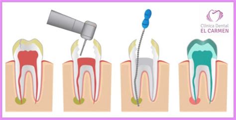 Clínica Dental El Carmen ¿quÉ Es Y En QuÉ Consiste Una Endodoncia