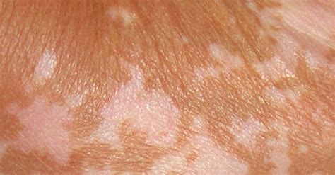 Discoloration Of Skin Causes Symptoms And Diagnosis