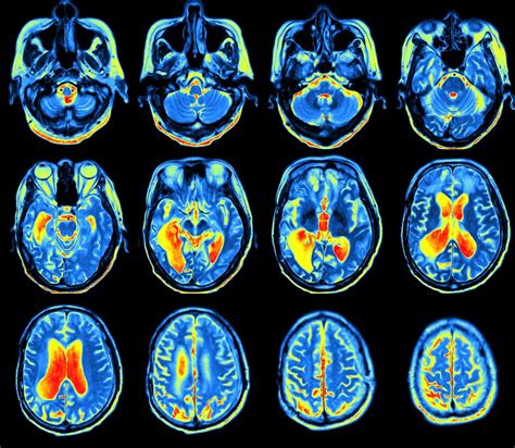 Pet Scan Distinguishes Juvenile Hd From Parkinsons In Case Study