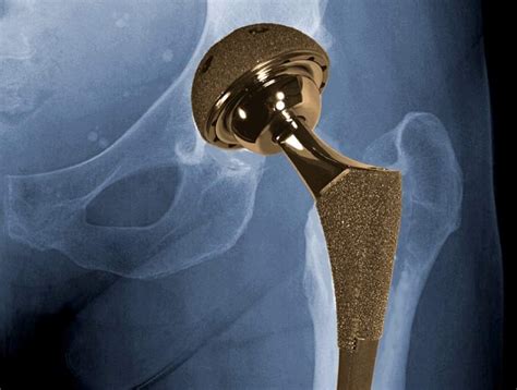 Nih Researchers Uncover Clues Related To Metal On Metal Hip Implants
