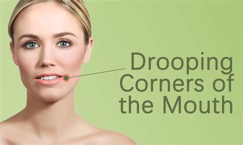 Drooping Corners Of The Mouth Treatment In Surat Elegance Clinic