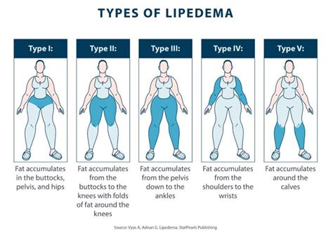 Lipedema Fibrosis Everything You Need To Know Tactile Medical
