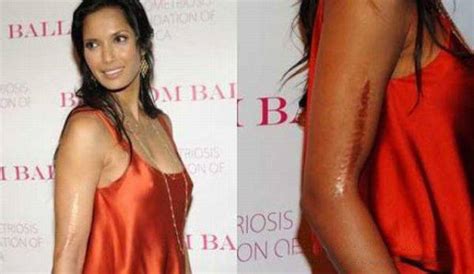 Body Defects In Celebrities You Didn T Know Thatviralfeed