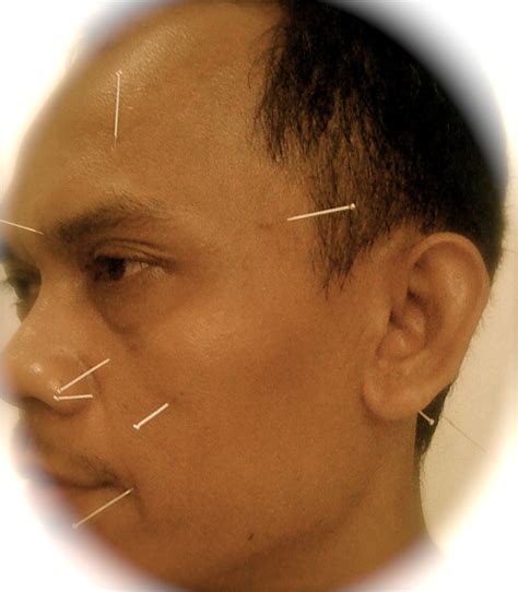 Akupunktur Di Boulevard Bukit Rivaria Depok Kelumpuhan Otot Wajah