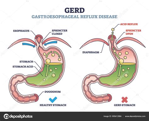 Gerd Atau Penyakit Refluks Gastroesofageal Dengan Diagram Garis Besar Asam Vektor Stok Oleh