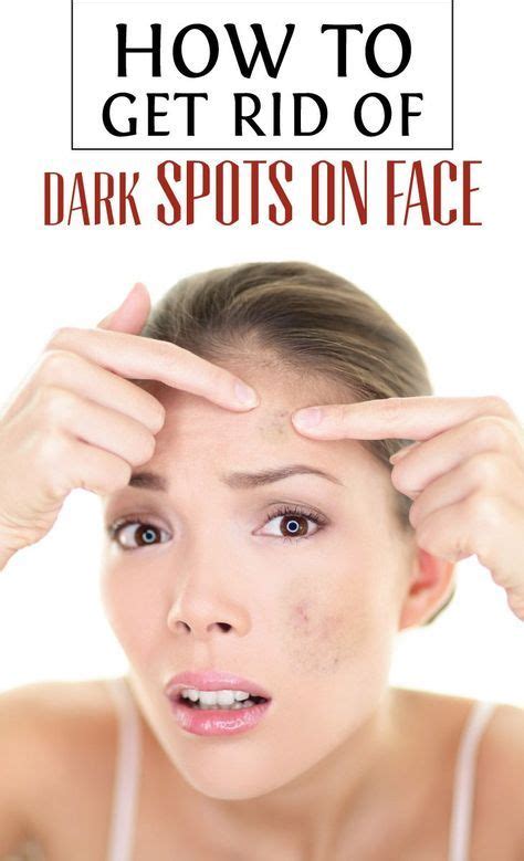 How To Get Rid Of Dark Spots On Face Cute Parents Spots On Face