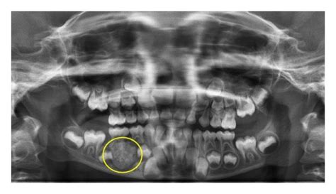 Preoperative Panoramic Radiograph With Radiopacity Surrounded By A