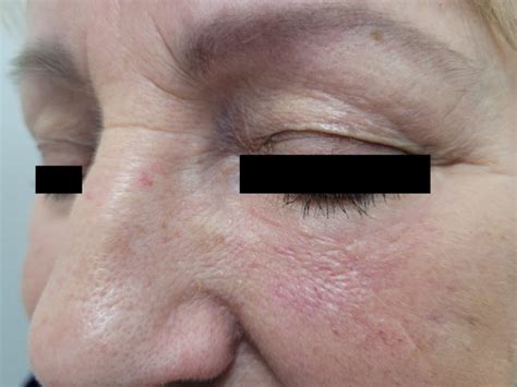 Bcc Left Lower Eyelid Dr Vindy Ghura Dermatologist Manchester