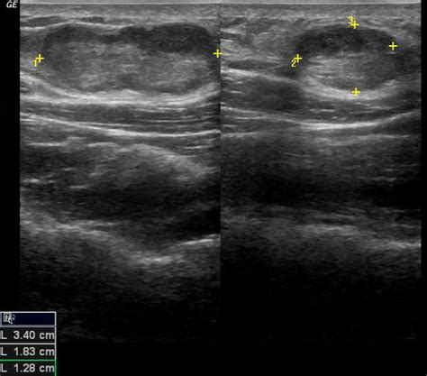 Liposarcoma On Ultrasound Image