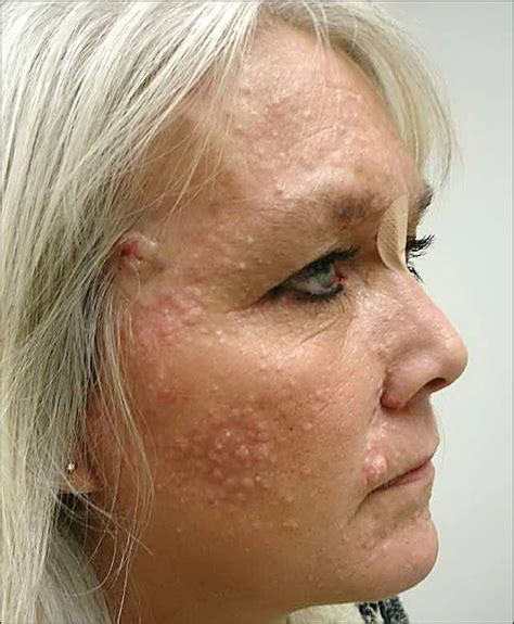 Numerous Facial Lesions In A 47 Year Old Woman—quiz Case Dermatology Jama Dermatology The