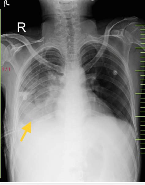 Chest X Ray Posteroanterior PA View Done After Insertion Of