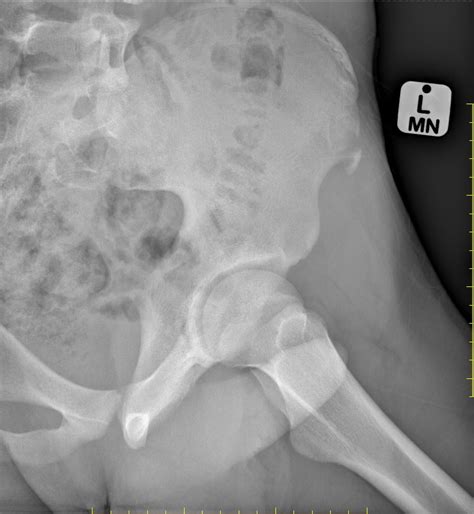 Anterior Superior Iliac Spine Asis Avulsion Injury Image