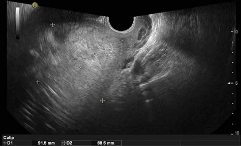 Case Of Decidual Discharge From The Nonpregnant Uterine Cavity Of The