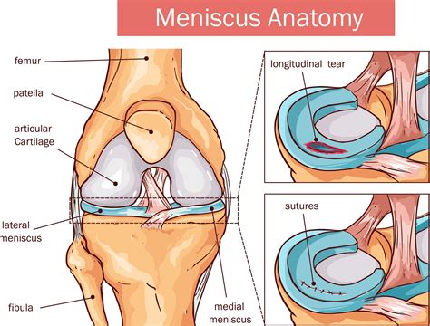 Knee Meniscus Surgeries Aptiva Health