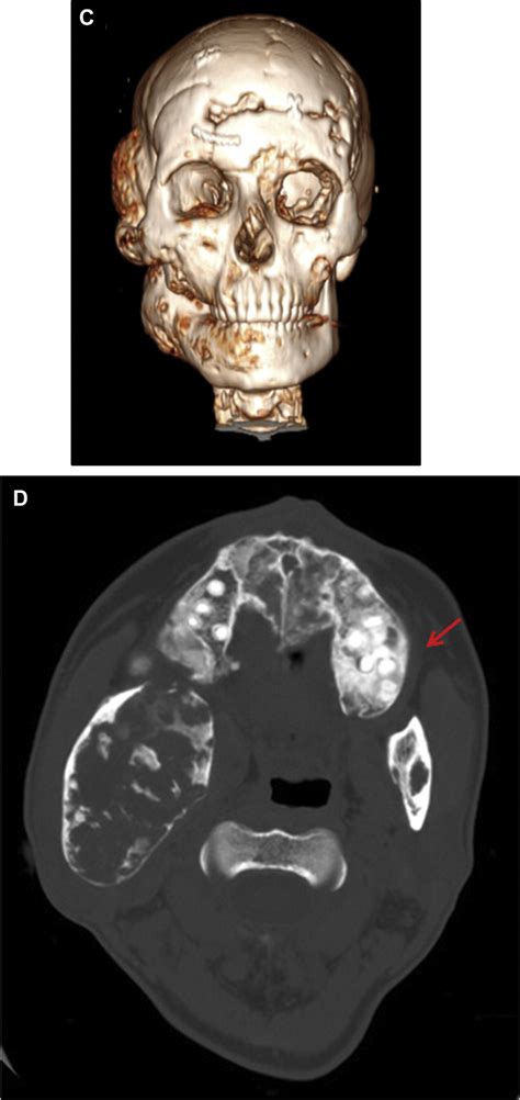 Contd C Three Dimensional Computed Tomogram Displays Facial