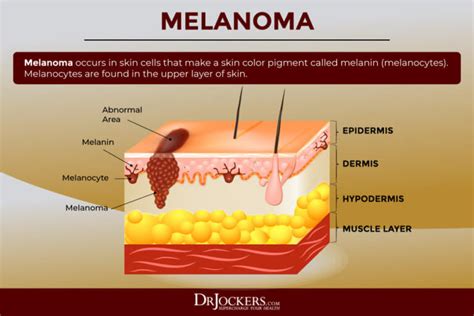 Skin Cancer Symptoms Causes And Natural Support Strategies