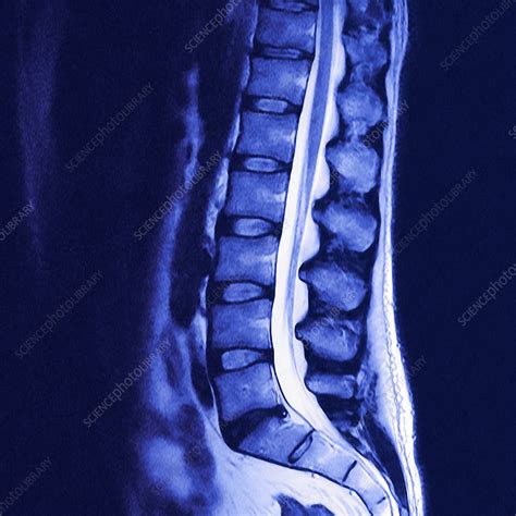 Lower Spine Mri Scan Stock Image P1160797 Science Photo Library