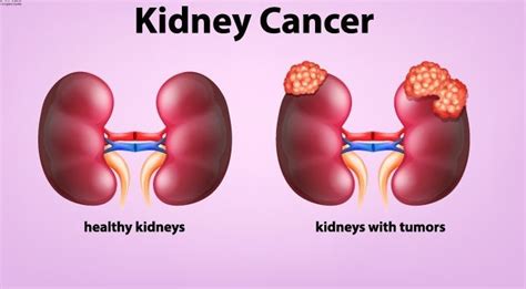 Kidney Cancer Its Types Symptoms Causes And Treatment Health