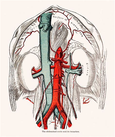 Aortic Dissection Illustrations Royalty Free Vector Graphics And Clip