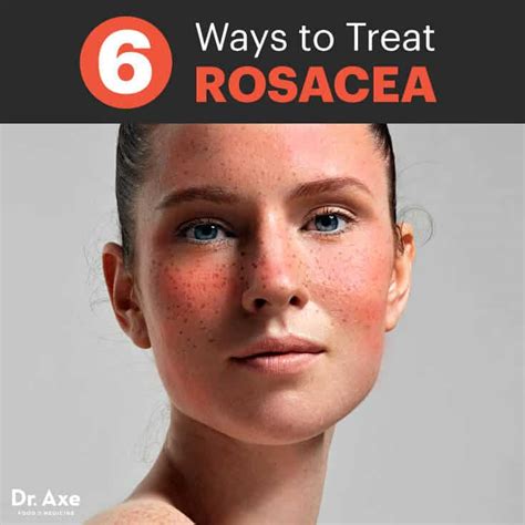 Rosacea Treatment 6 Natural Remedies To Use Dr Axe