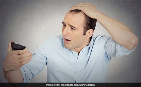 Researchers Find New Potential Cure For Baldness Top 5 Foods That