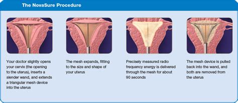 Endometrial Ablation Women S Health Specialists