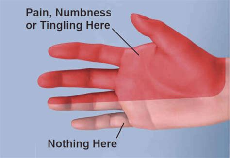 Guide To Fixing Numb Hands While Sleeping At Night