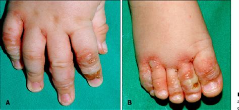 Figure 2 From A Case Of Acrodermatitis Enteropathica Localized On The