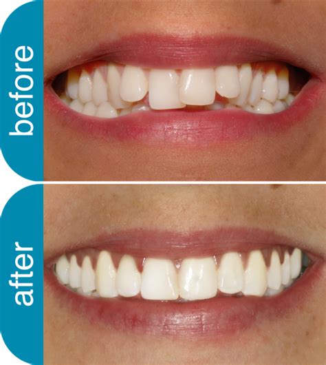 Invisalign Crooked Teeth Before And After Teeth Poster