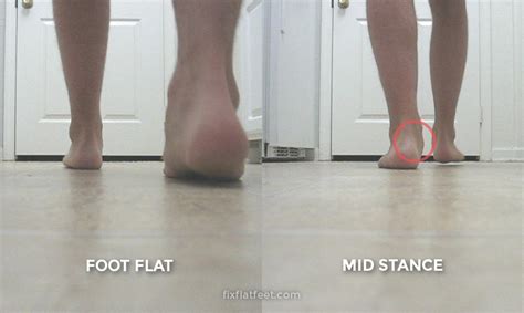 The Difference Between Flat Feet And Overpronation Somastruct