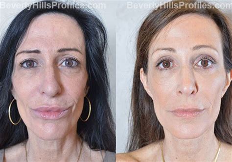 Browlift Before After Photos Beverly Hills LA Browlift