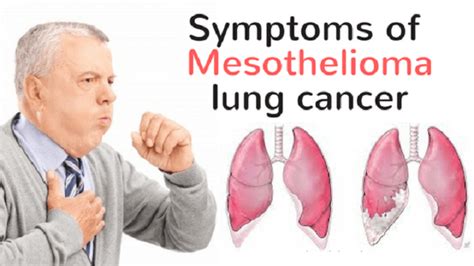 The symptoms are often misdiagnosed as lung cancer or another illness. My Health Care: Mesothelioma Symptoms, Diagonsis, and ...