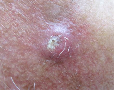 What Does A Squamous Cell Skin Cancer Look Like Cancerwalls