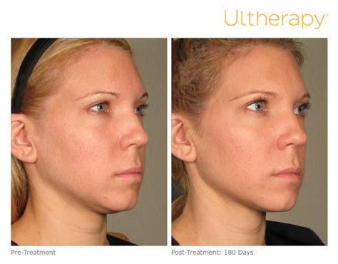 Lift This Summer Without Surgery With Ultherapy Skin Tightening