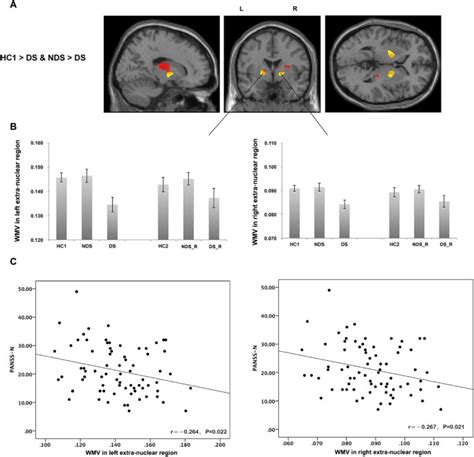 white matter alterations in first episode treatment naïve patients with deficit schizophrenia a