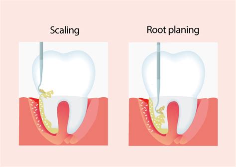 Copy Of The Difference Between Scaling And Root Planing Deep Cleaning