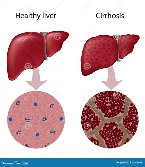 Diagram Of Liver Cirrhosis Dr Manohar Lal Sharma Gastroenterologist My Xxx Hot Girl