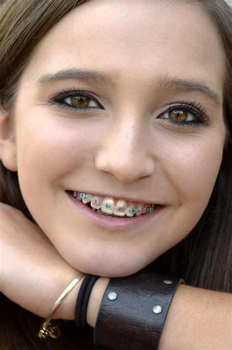 The Best Best Color For Braces That Isn T Noticeable References