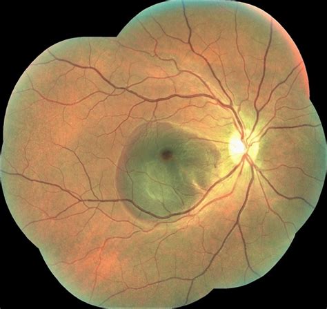 Traumatic Submacular Hemorrhage Retina Image Bank