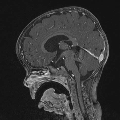J Shaped Sella And Simple Pituitary Cyst Image