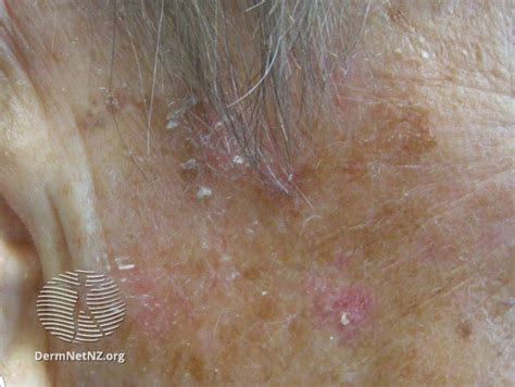 Actinic Keratoses Affecting The Face Dermnet Nz Lesions Ak Face Nc