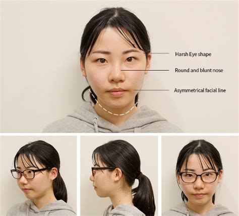 Japanese Model Azusas Plastic Surgery Transformation At Id Hospital