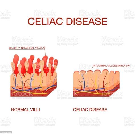 Different Types Of Celiac Disease And Gluten Free Diet Enriqueburgos