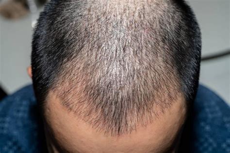 Discover How To Treat Hair Loss