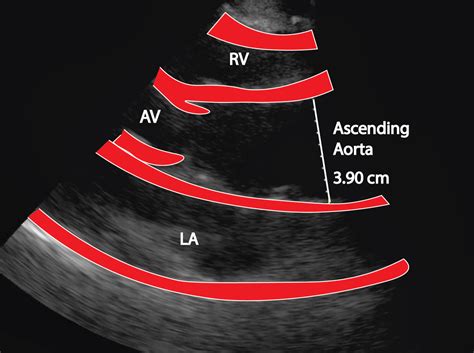 Discovering The Aorta Through Ultrasound Critical Care Sonography