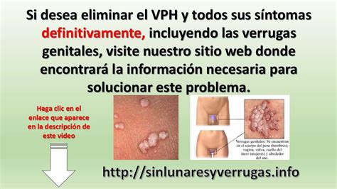 Verrugas Genitales En Hombres Vph En Hombres Causas Sintomas Y Images