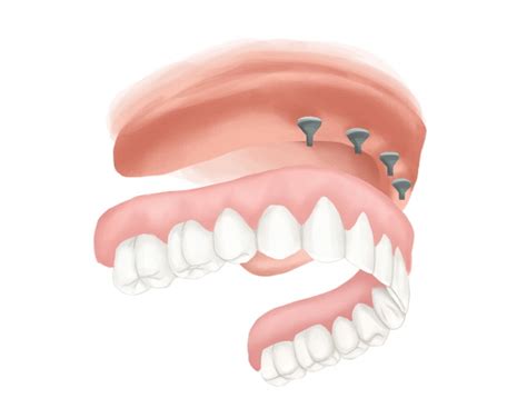 Most implant centers such as our office and clear choice will charge one flat fee to remove all the teeth clearly some full implant options perform and look differently too. Full mouth dental implant cost Oakland, CA | How much are ...